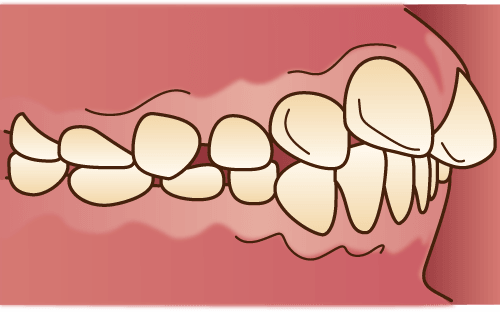 上顎前突(じょうがくぜんとつ)