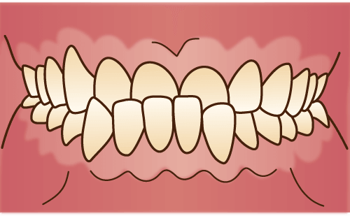 下顎前突(かがくぜんとつ)