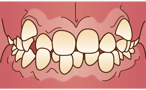 叢生(そうせい)
