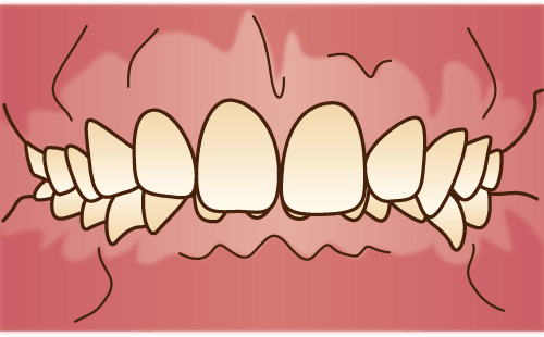 過蓋咬合(かがいこうごう)