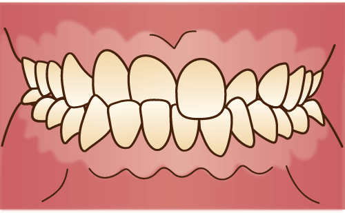 交叉咬合(こうさこうごう)