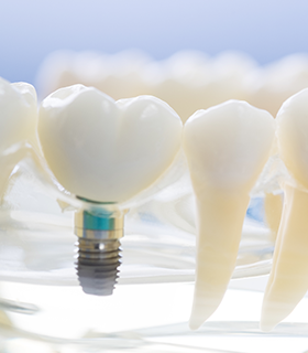 インプラントとは