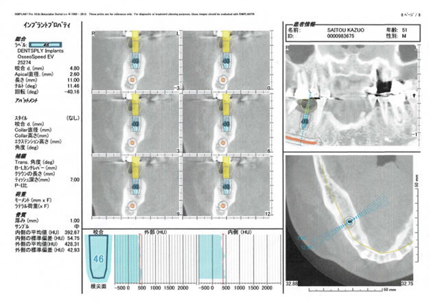 インプラント設計図