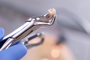 歯の移植・再植について